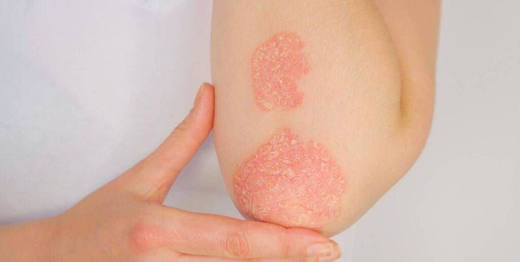 Hestemælk mod psoriasis