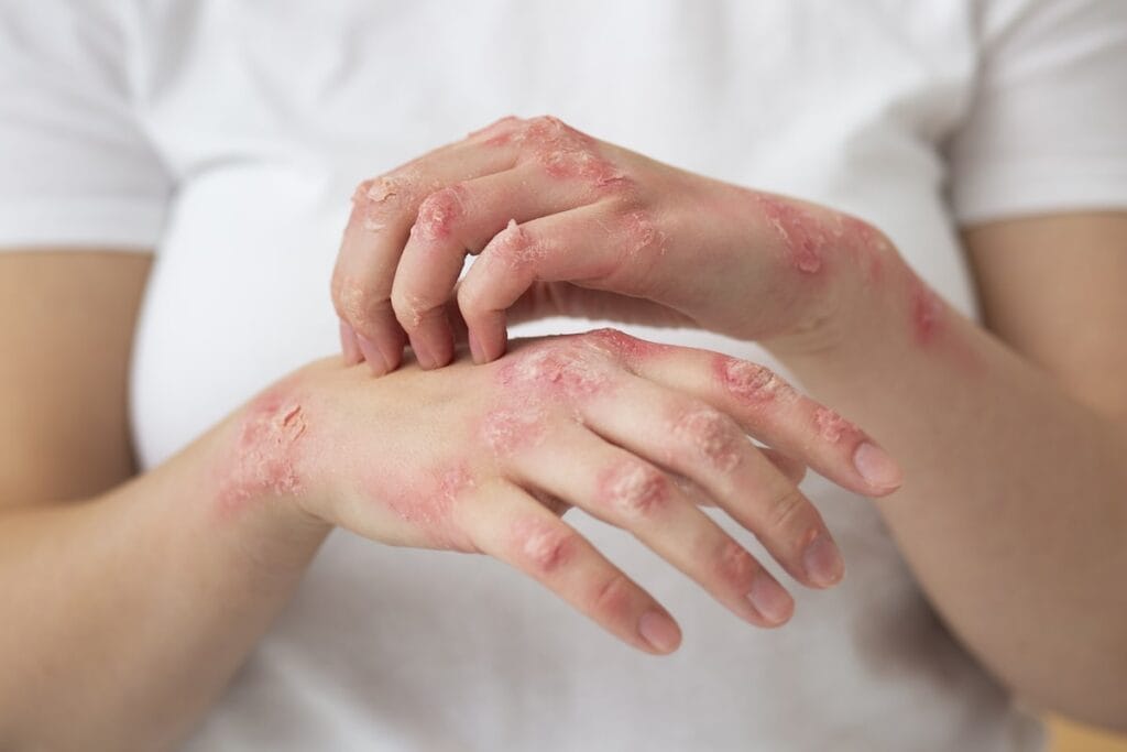 eczema