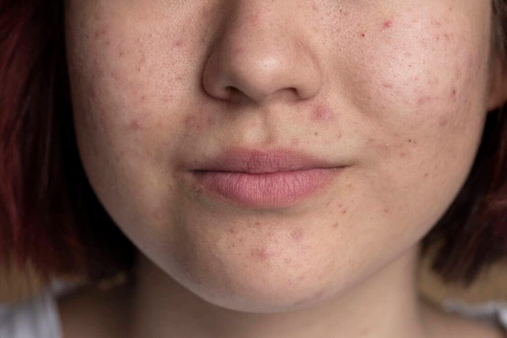 acne